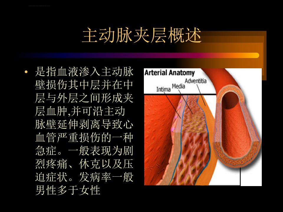 主动脉夹层讲课ppt课件