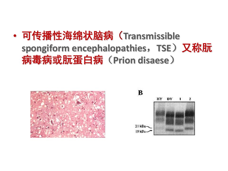 可传播性海绵状脑病精品课件