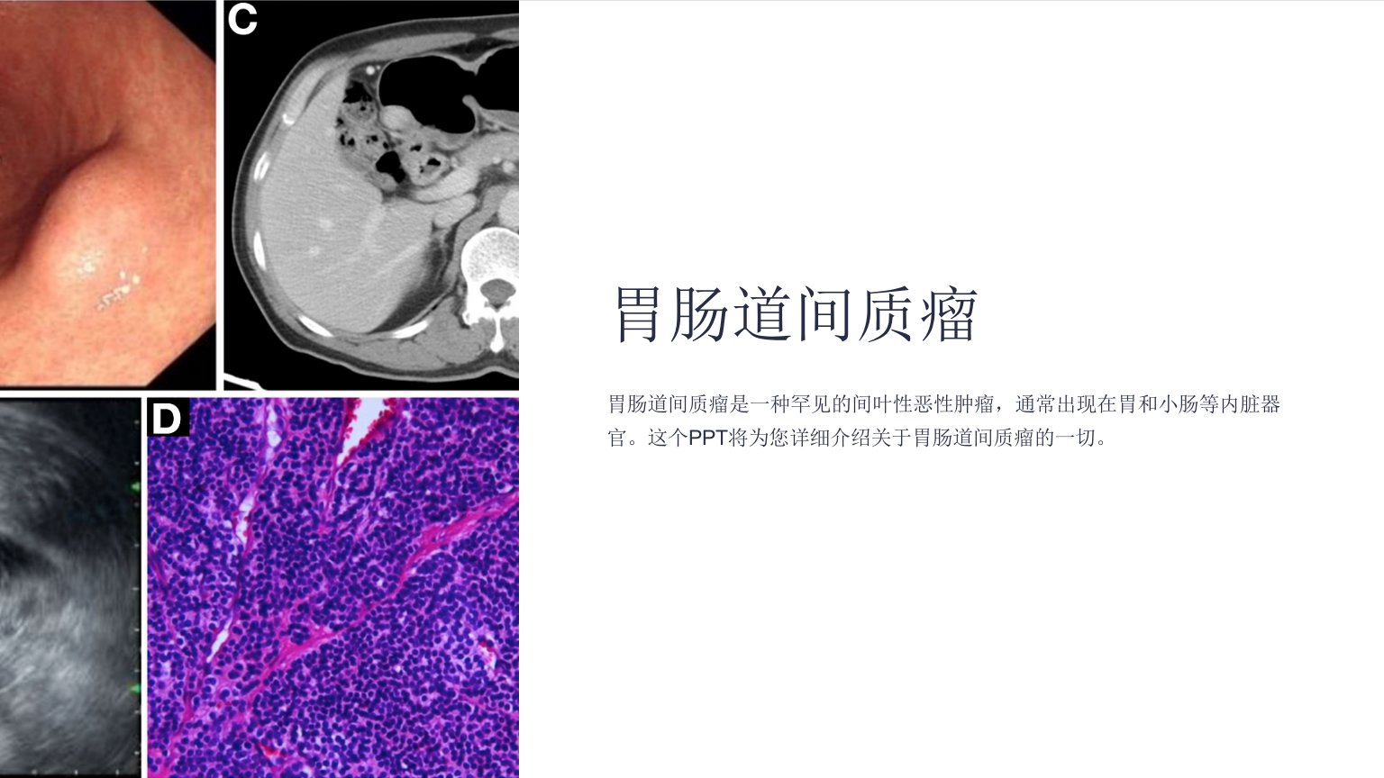 《胃肠道间质瘤》课件