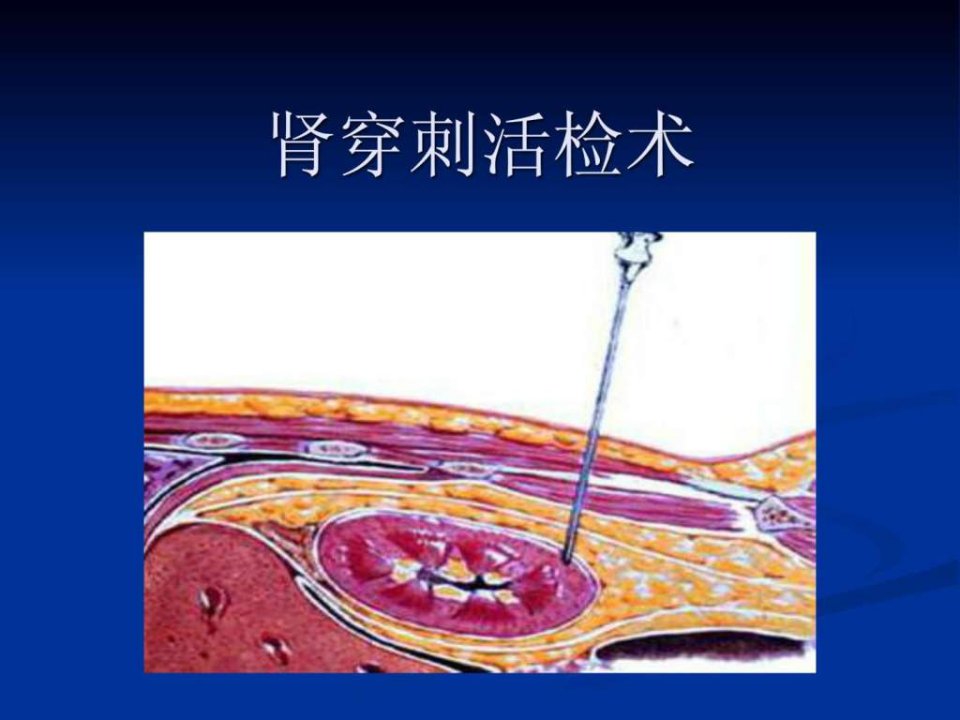 肾穿刺活检术图文ppt课件