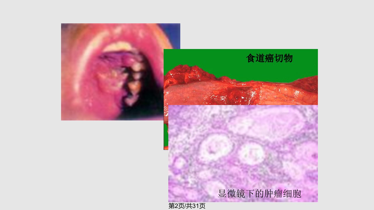 肿瘤和冠心病