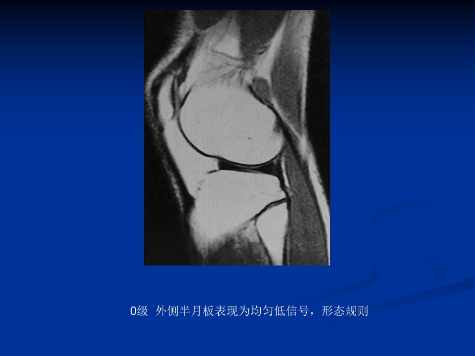 膝关节半月板损伤MRI