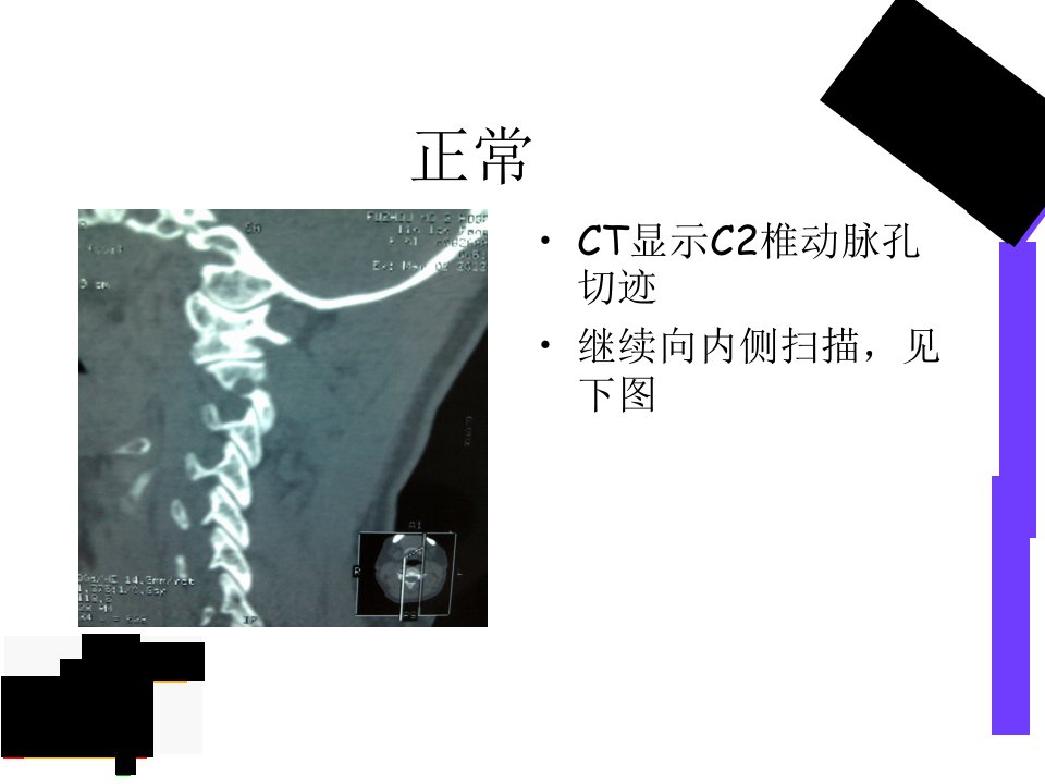 椎动脉高跨ppt课件