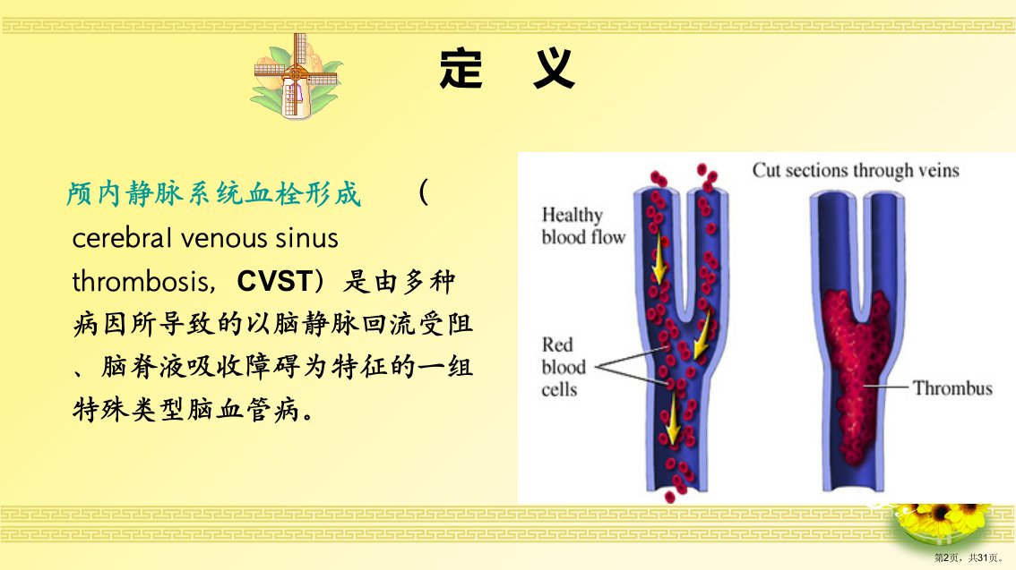 一例颅内静脉窦血栓形成病人的护理教学课件