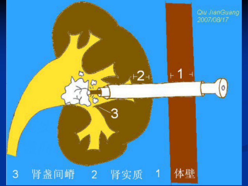 经皮肾镜碎石取石术