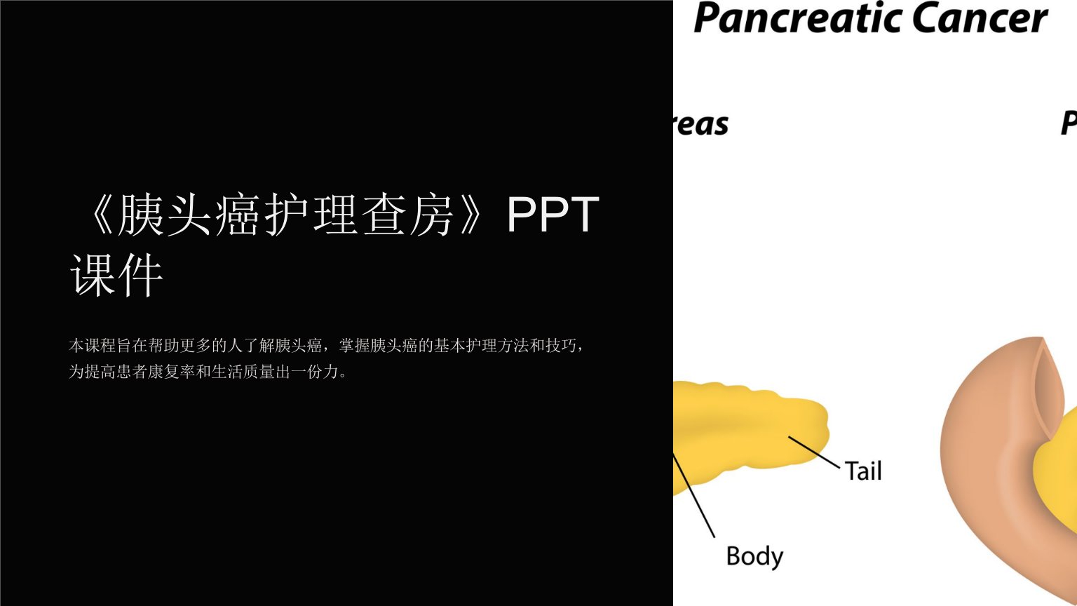 《胰头癌护理查房》课件