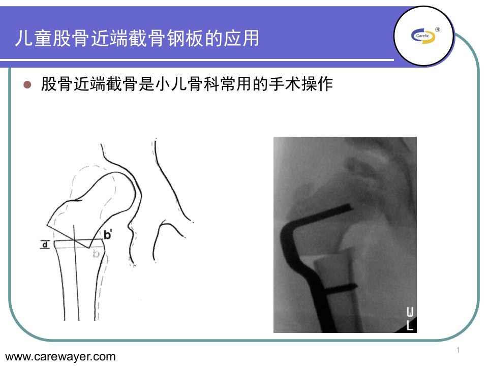 lcppediatricplate的临床应用课件