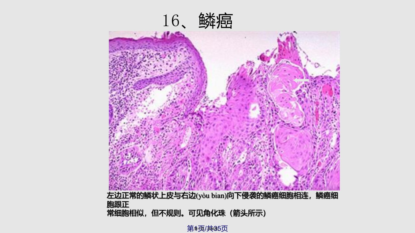 病理学图谱实验五一肿瘤实用教案