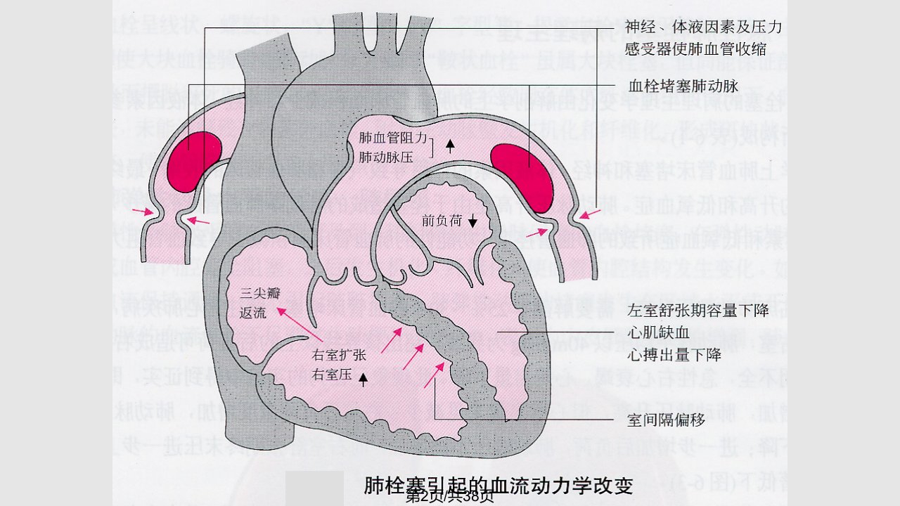 肺栓塞1学习教程