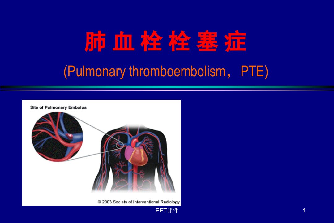 内科学--肺栓塞