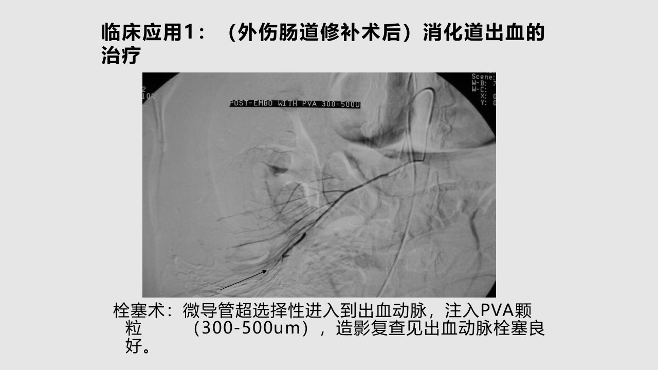 急性动脉性出血的介入治疗