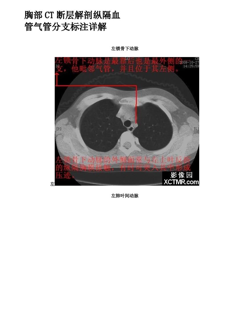 胸部CT断层解剖纵隔血管气管分支标注详解