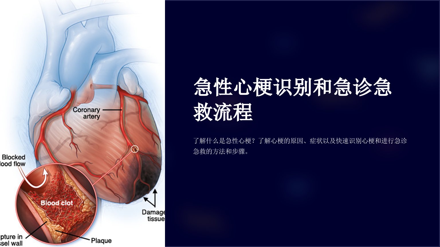 急性心梗识别和急诊急救流程课件