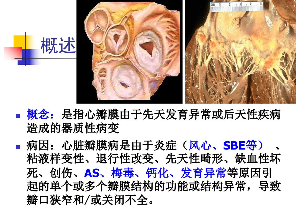 最新心瓣膜病1PPT课件