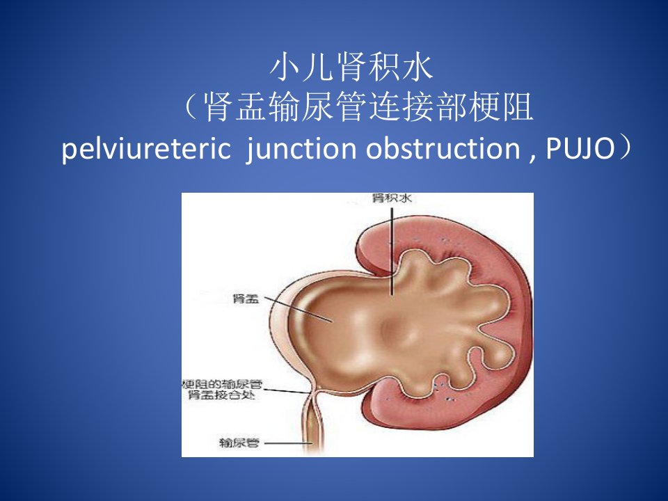 小儿肾积水课件