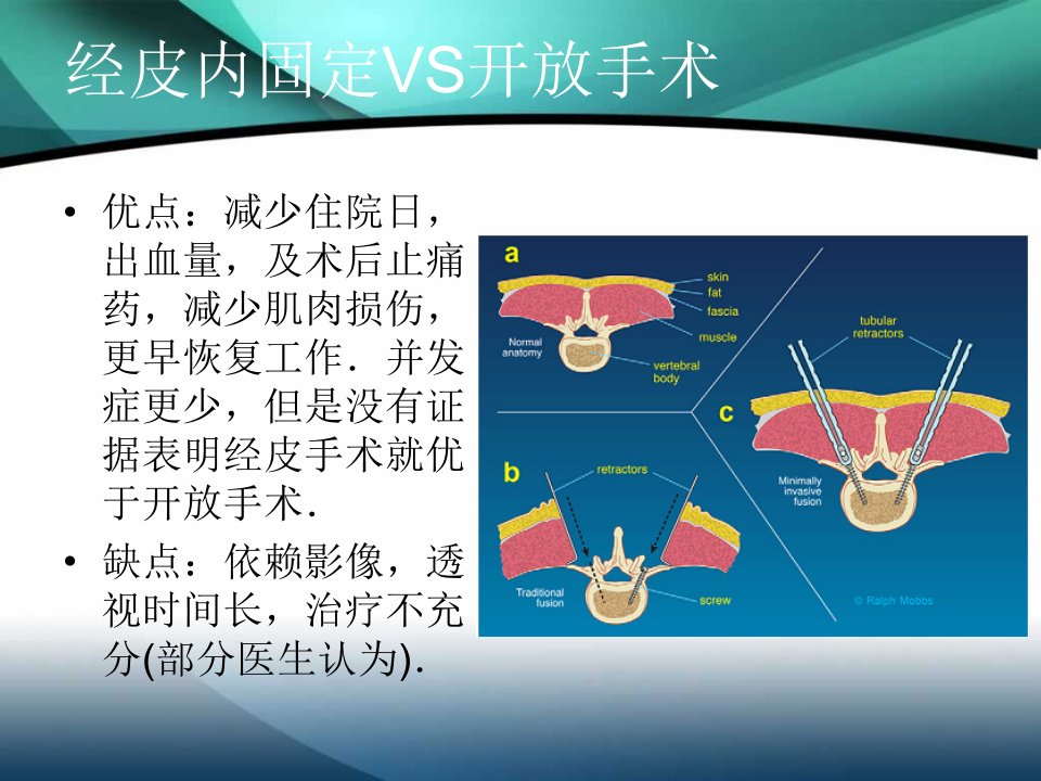 经皮椎弓根螺钉固定的技术