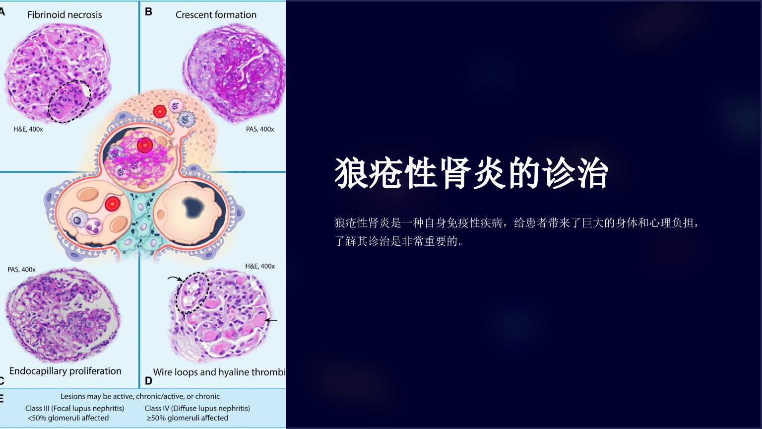 《狼疮性肾炎的诊治》课件