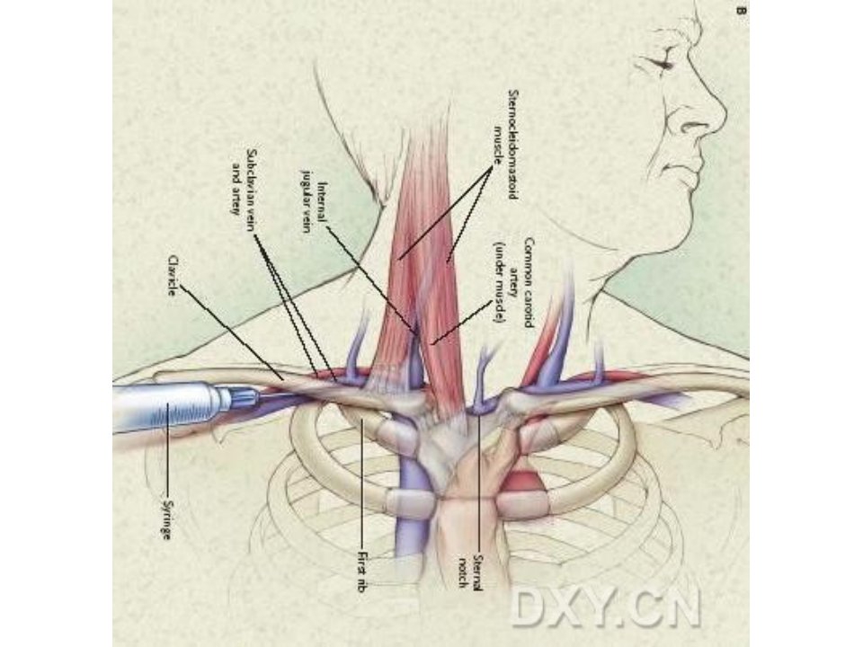锁骨下静脉穿刺图示1