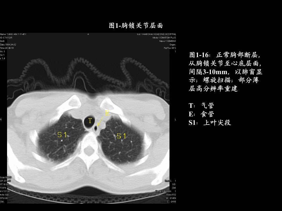 胸部ct解剖及典型病例CT征象