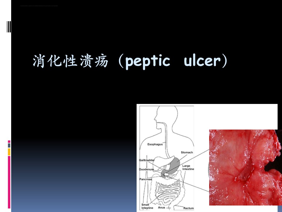 消化性胃溃疡用药ppt课件