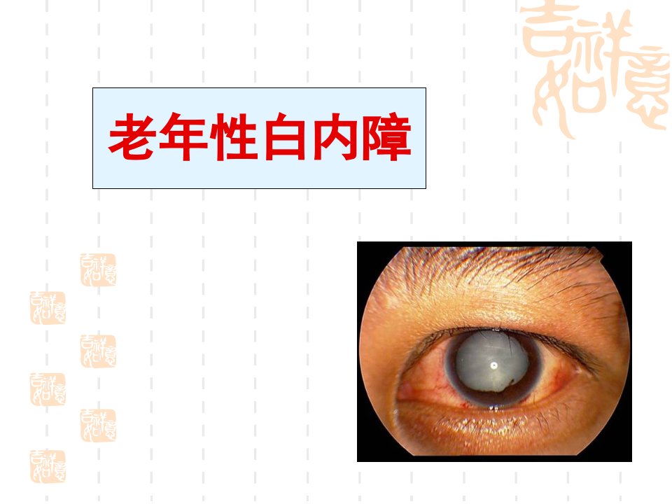 [整理版]老年性白内障