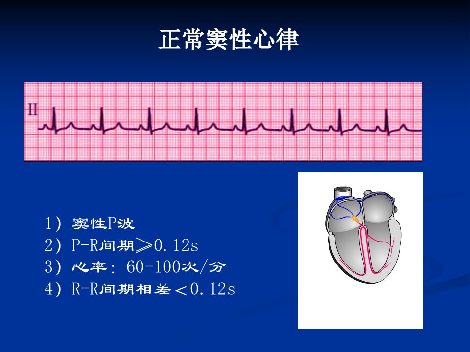 第讲窦性心律失常、病窦课件