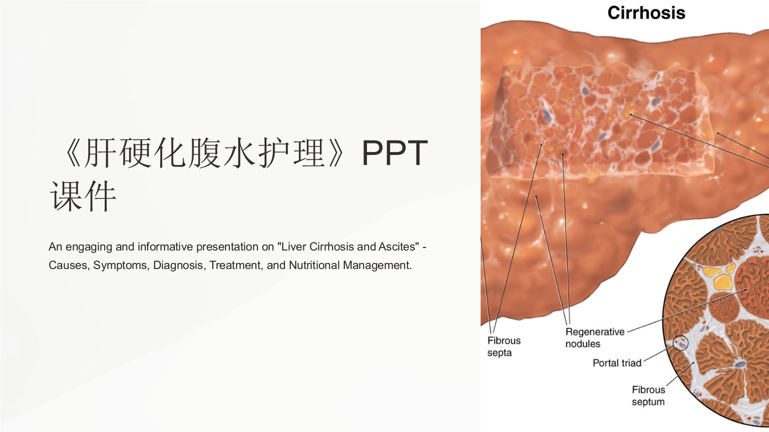 《肝硬化腹水护理》课件