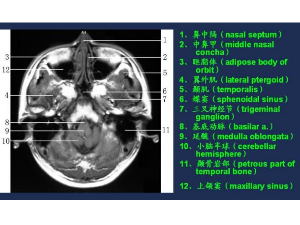 MRI常用解剖