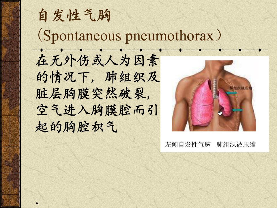 张力性气胸幻灯片