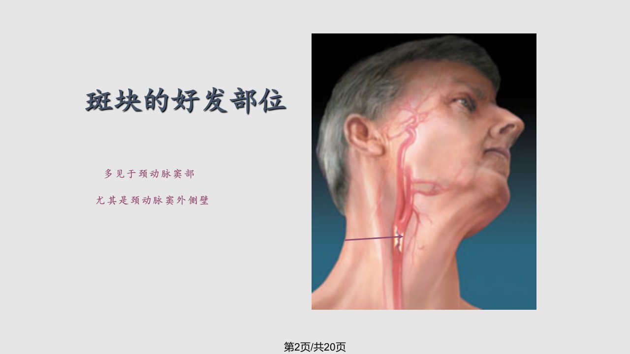 颈动脉斑块专题