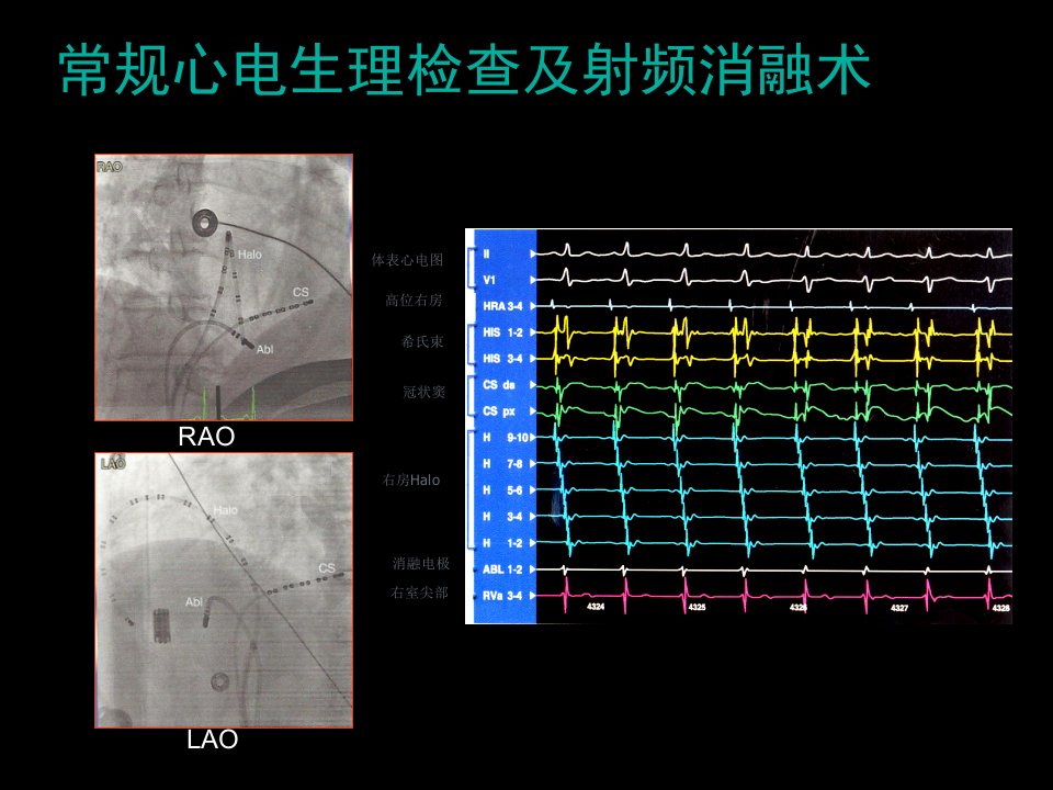 全三维指导下的室上速消融课件