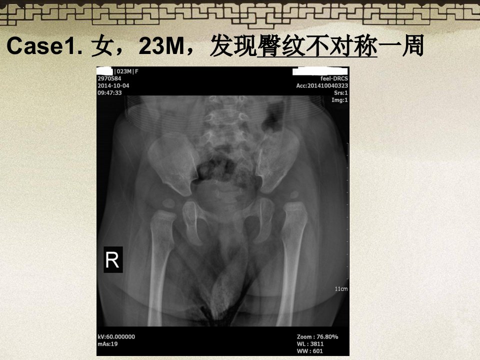 DDH发育性髋关节脱位