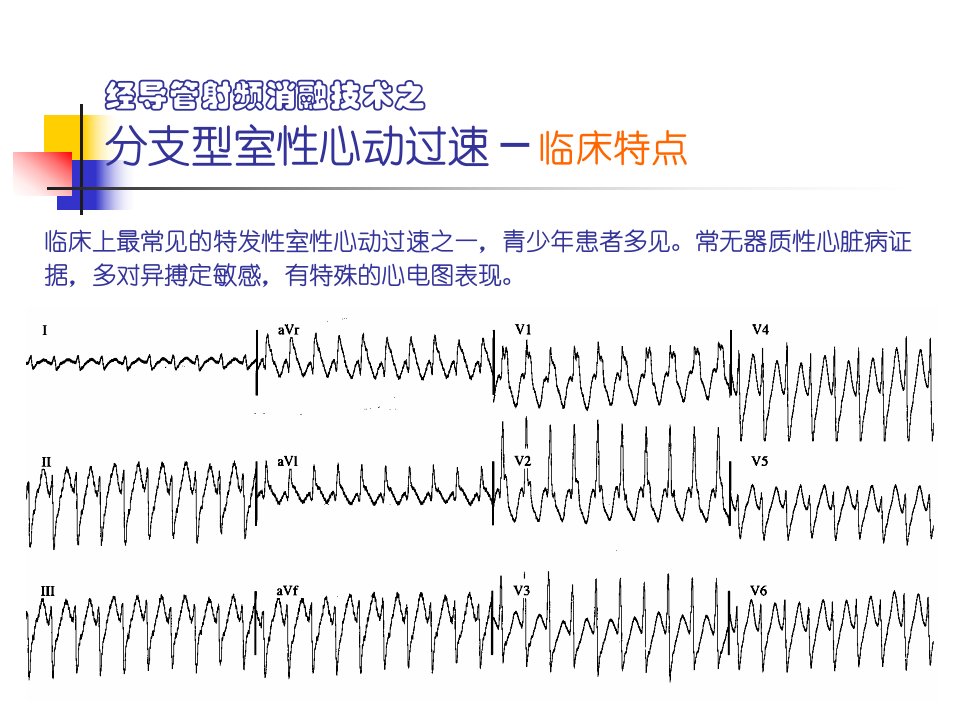 分支型室速的标测与消融