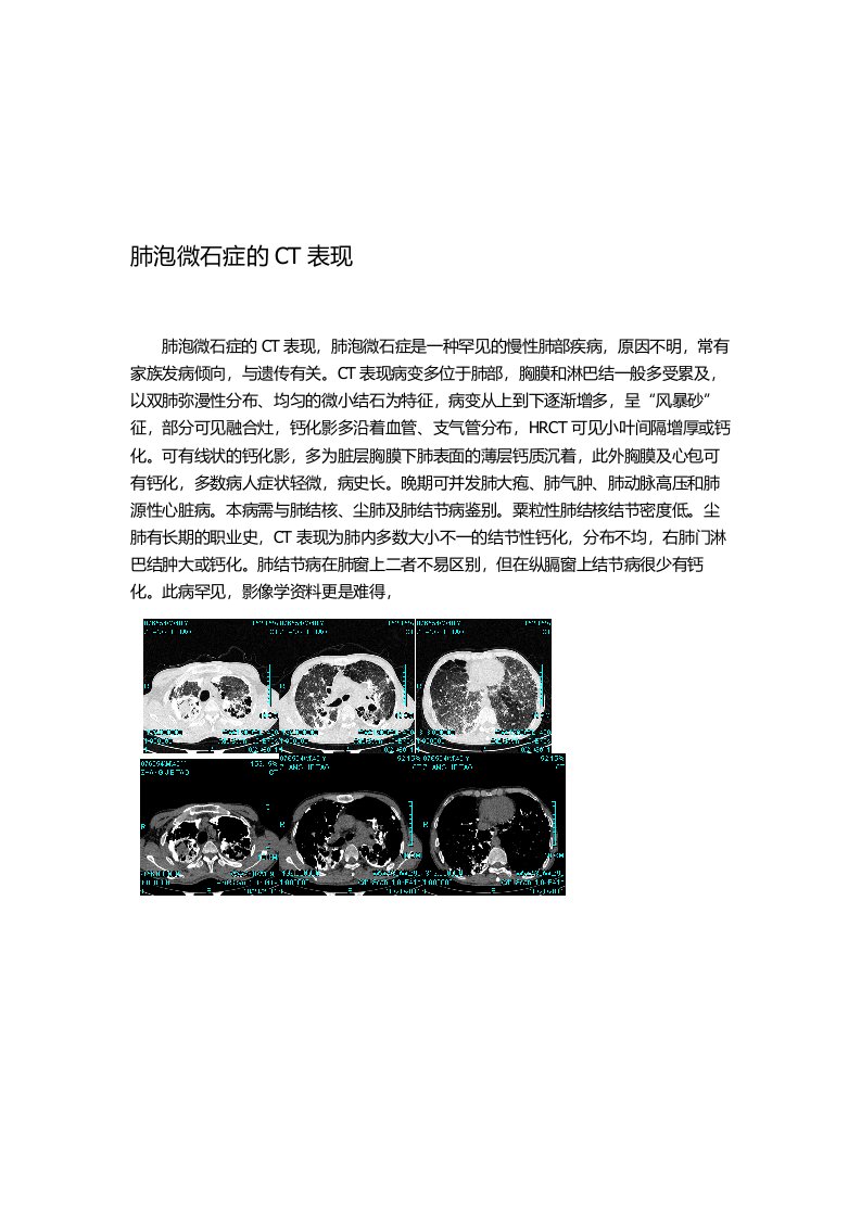 肺泡微石症的CT表现