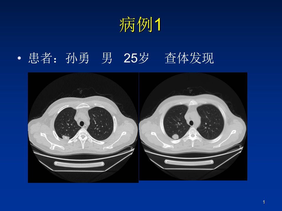 医学--肺错构瘤影像表现课件