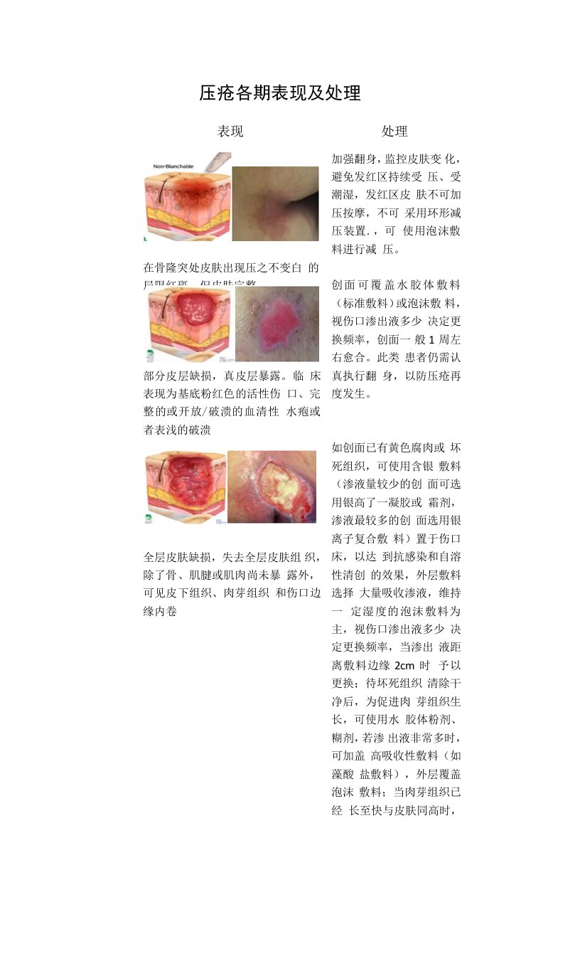 压疮各期表现及处理