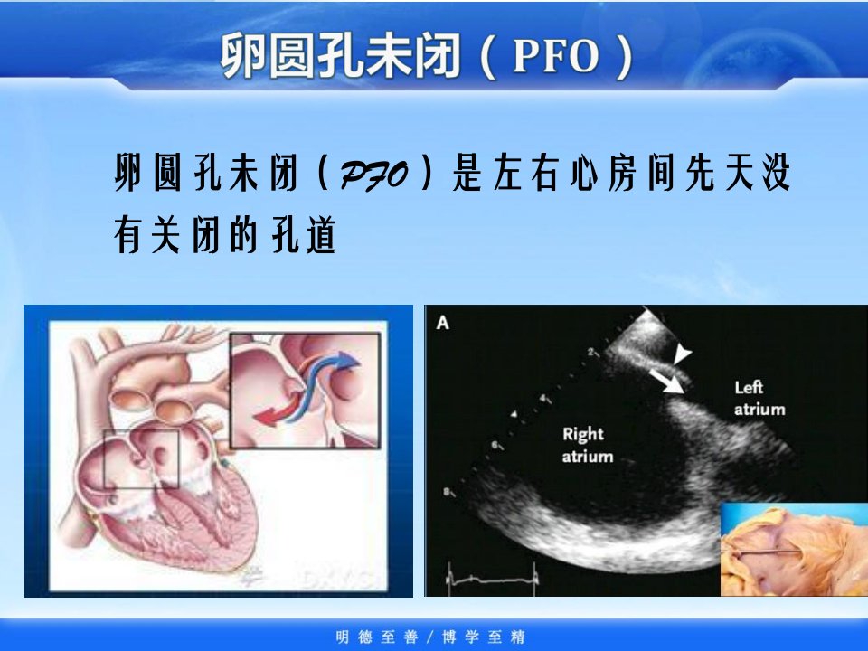 卵圆孔未闭PFO与不明原因卒中和偏头痛治疗策略