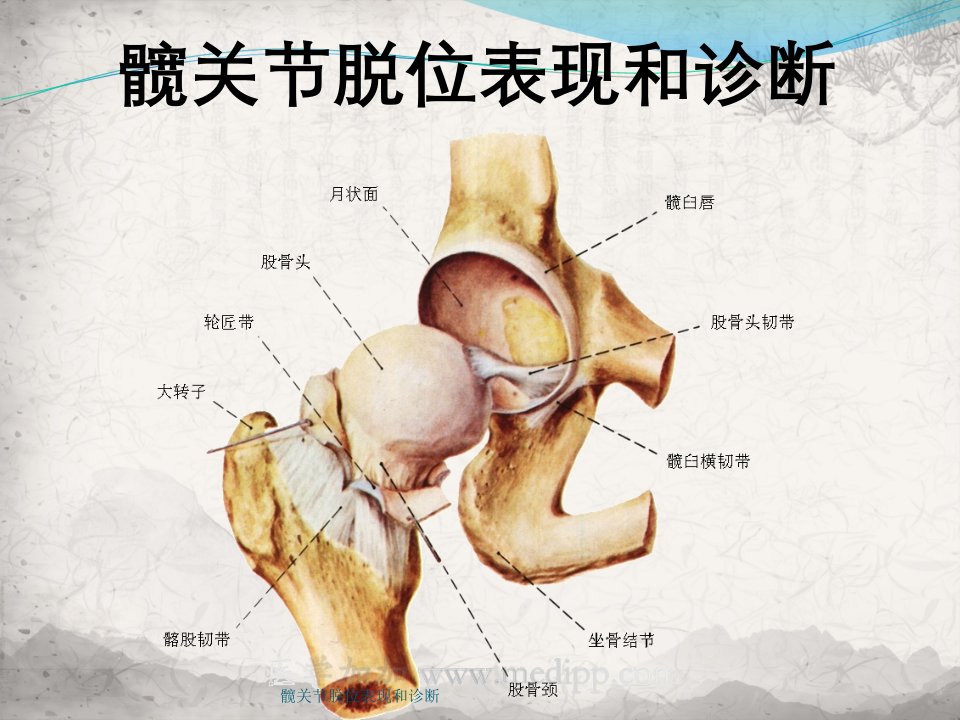 髋关节脱位表现及诊断