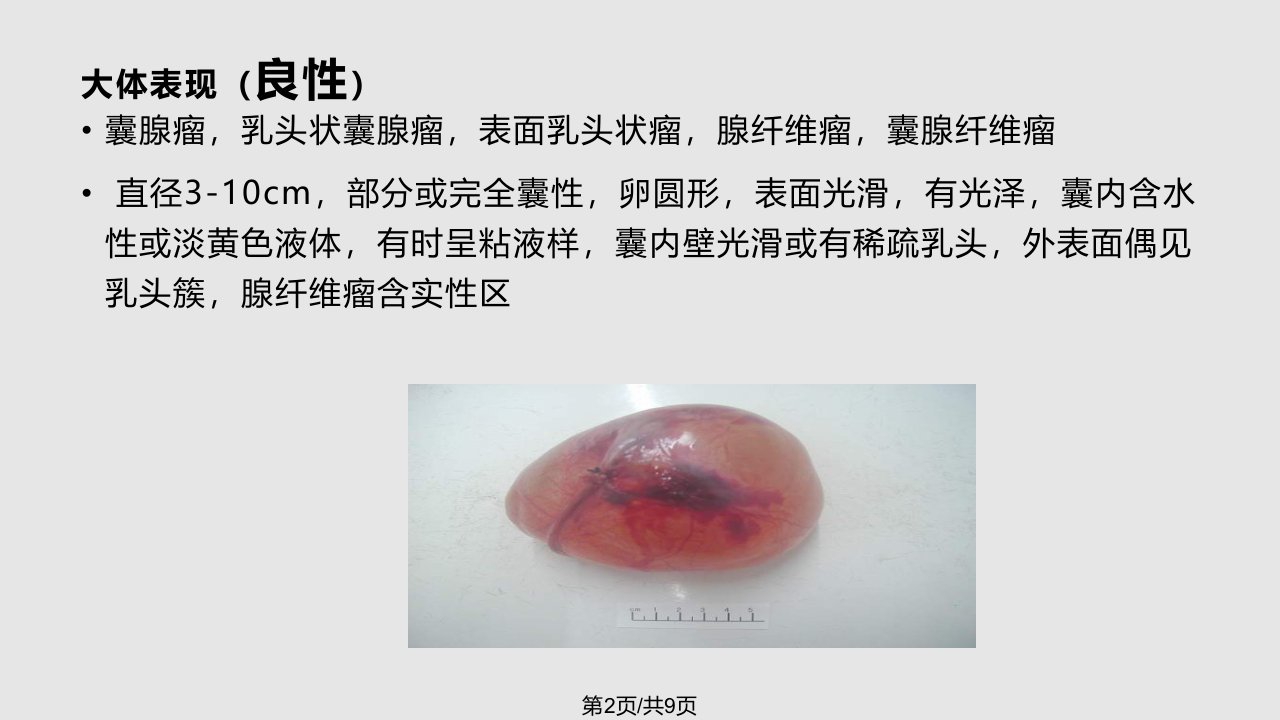 浆液性囊腺瘤