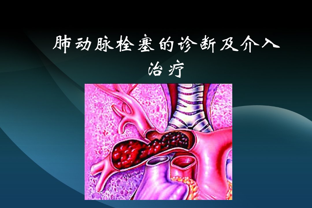 肺栓塞的诊断和介入治疗ppt课件