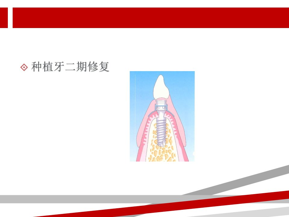 种植牙二期修复