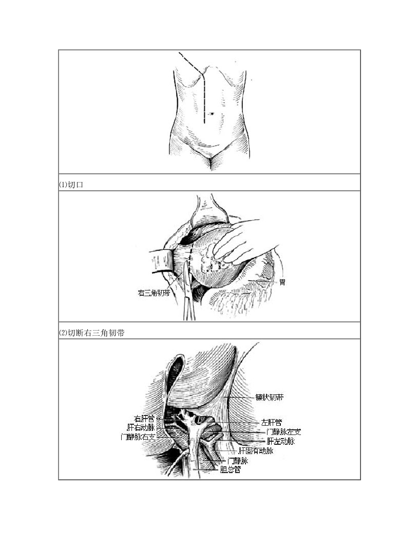 肝右叶切除术