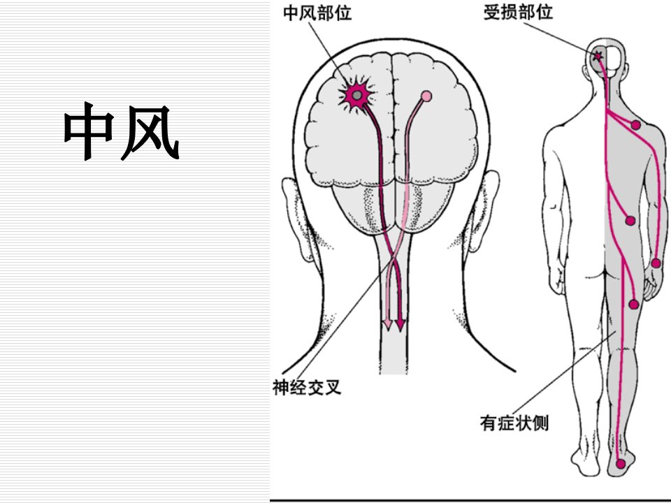 中风1