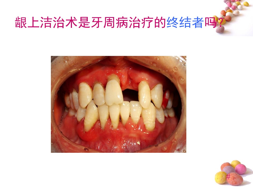 龈下刮治术