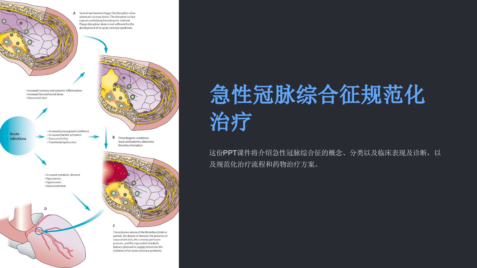 急性冠脉综合征规范化治疗课件