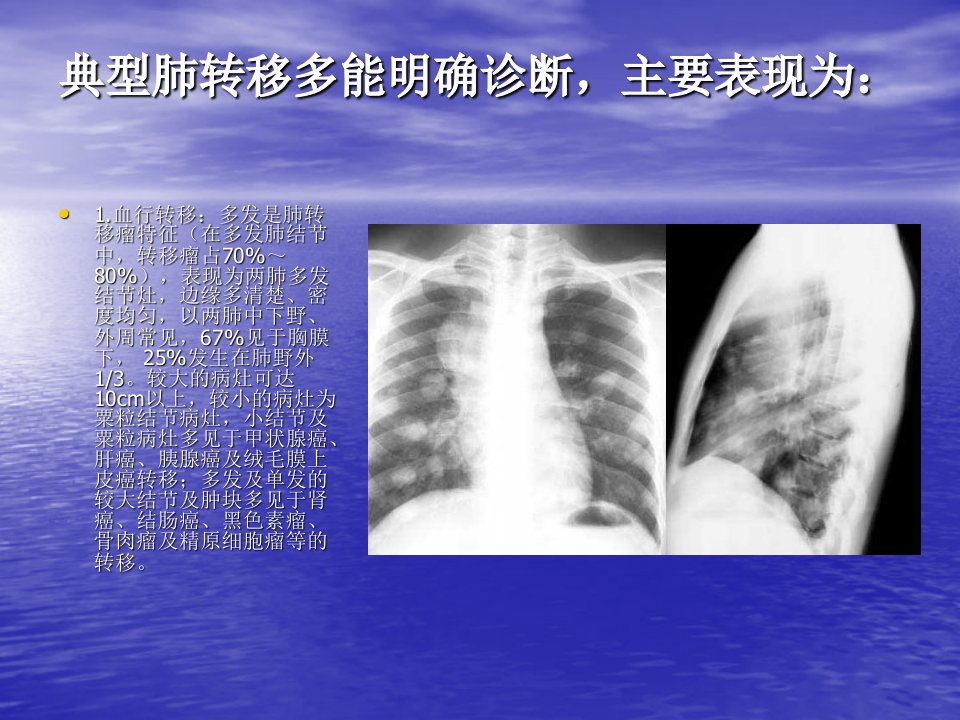 3肺部转移瘤的影像诊断