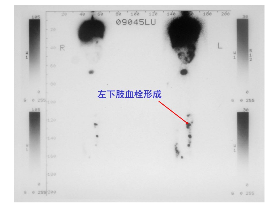 急性肺栓塞图片PPT课件