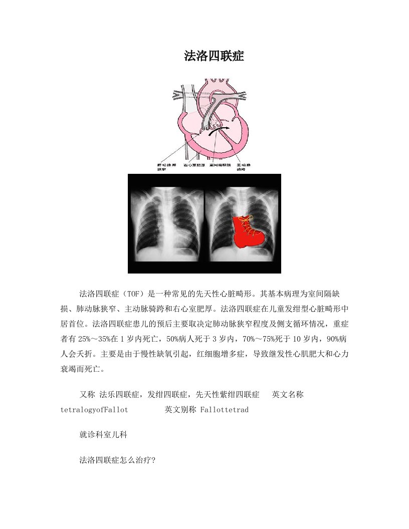 法洛四联症详细图文解惑