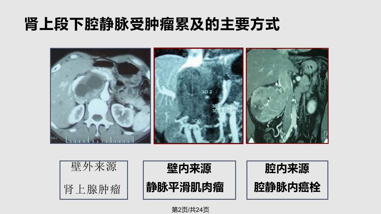 肿瘤累及肾上段下腔静脉手术径路