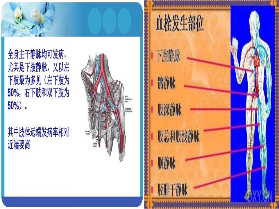 医学专题下肢深静脉血栓